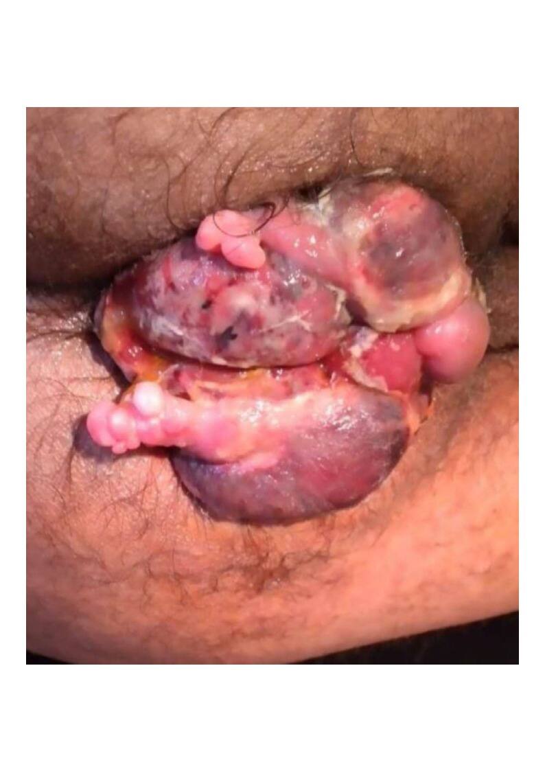 Pre-operative photograph of massive circumferential prolapsed gangrenous haemorrhoidal mass